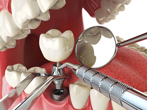 Best Emergency Root Canal Treatment in Northview, MI